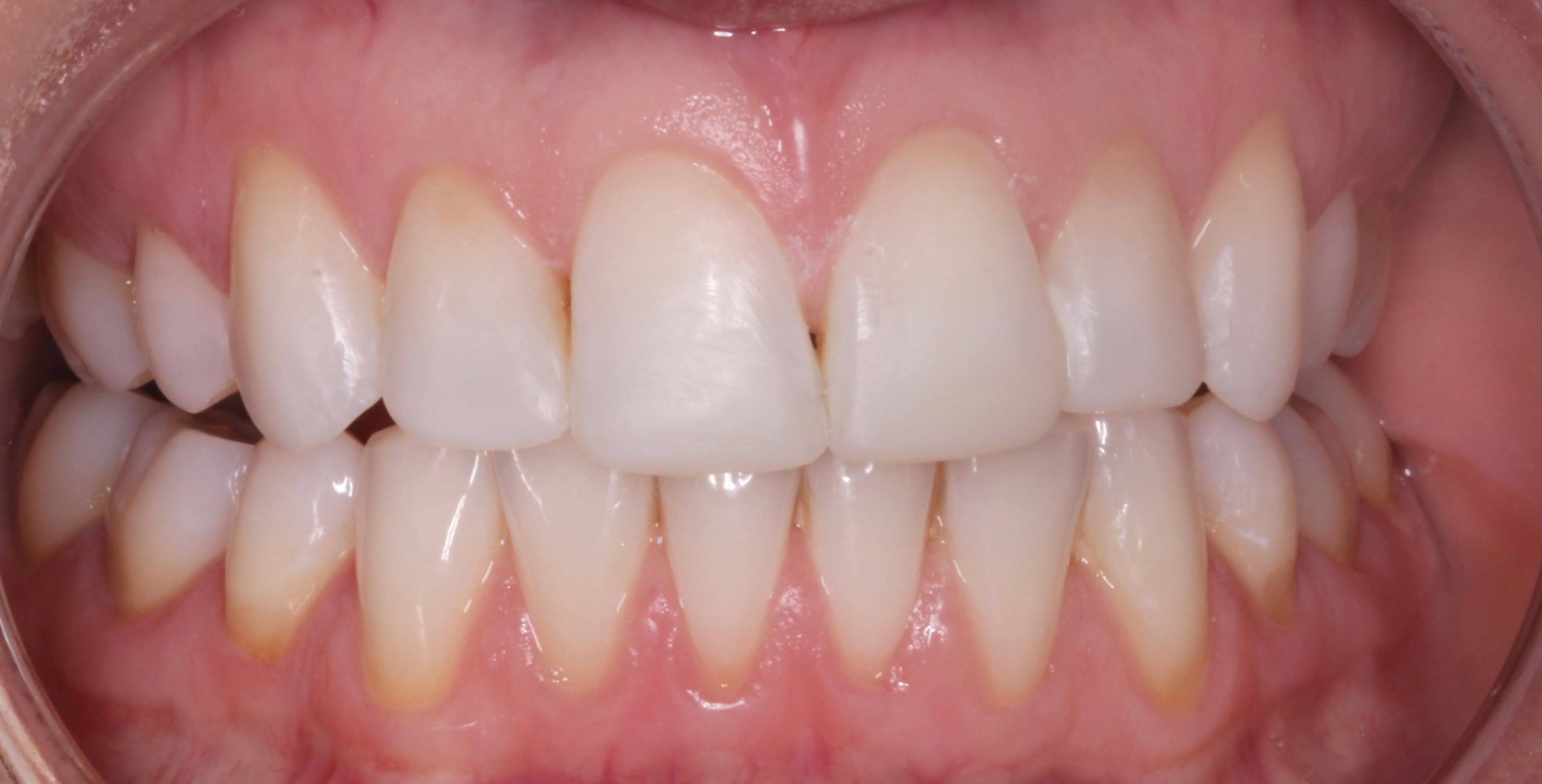 Invisalign - After procedure1