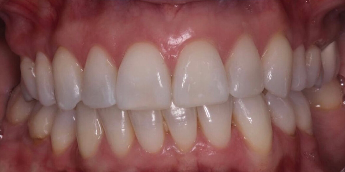 Invisalign - After