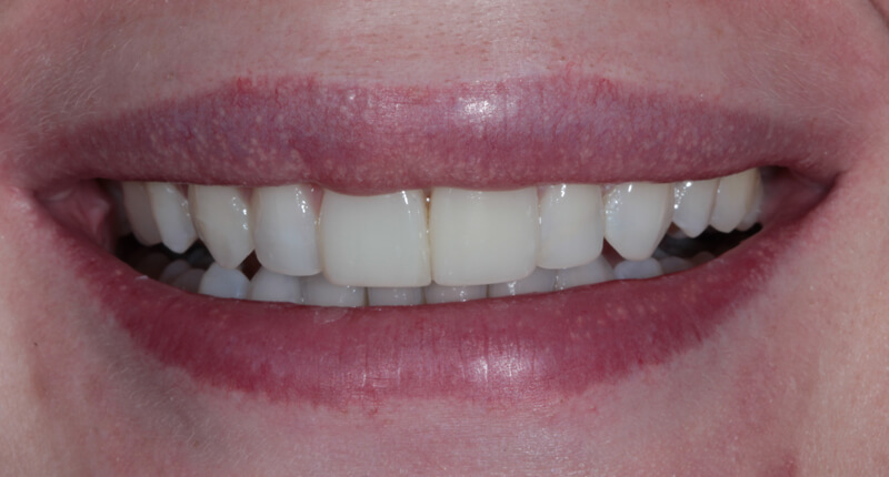 Invisalign Case 1 After