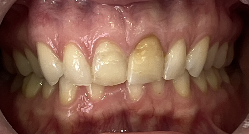 Invisalign Case 1 Before