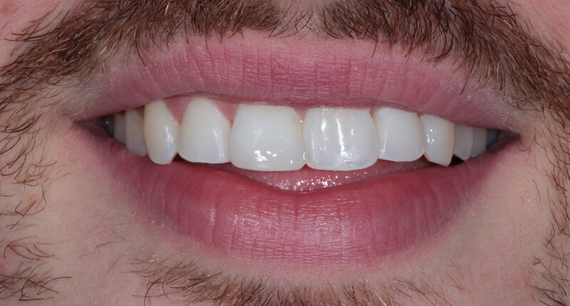 Invisalign Case 2 After