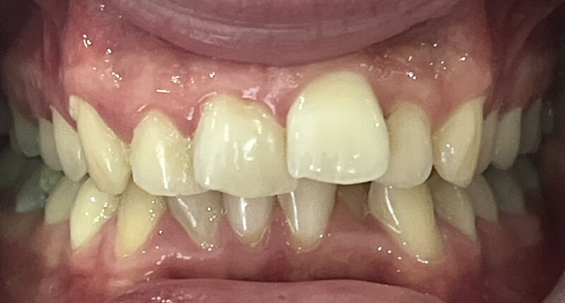 Invisalign Case 2 Before