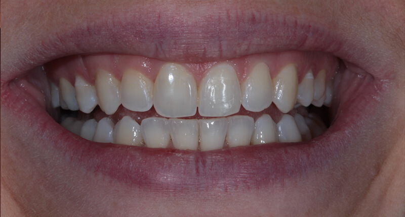 Invisalign Case 3 After