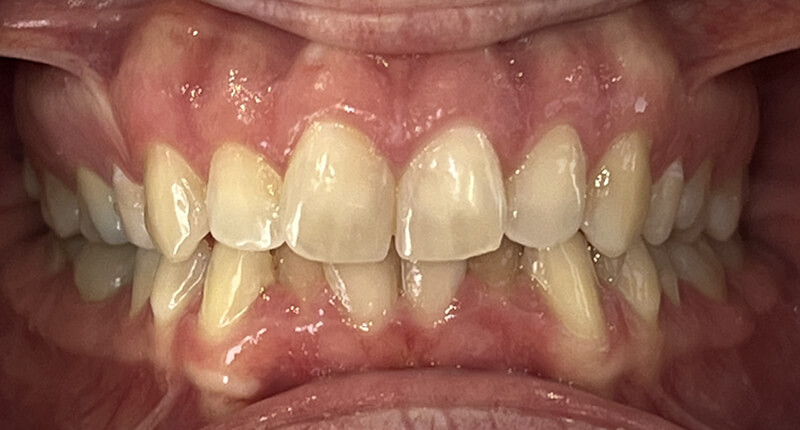 Invisalign Case 3 Before