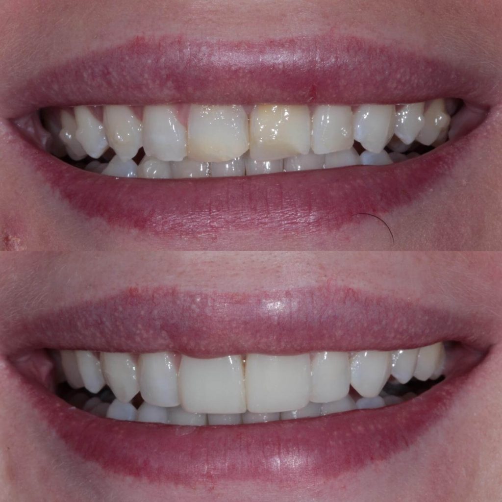 Invisalign Case