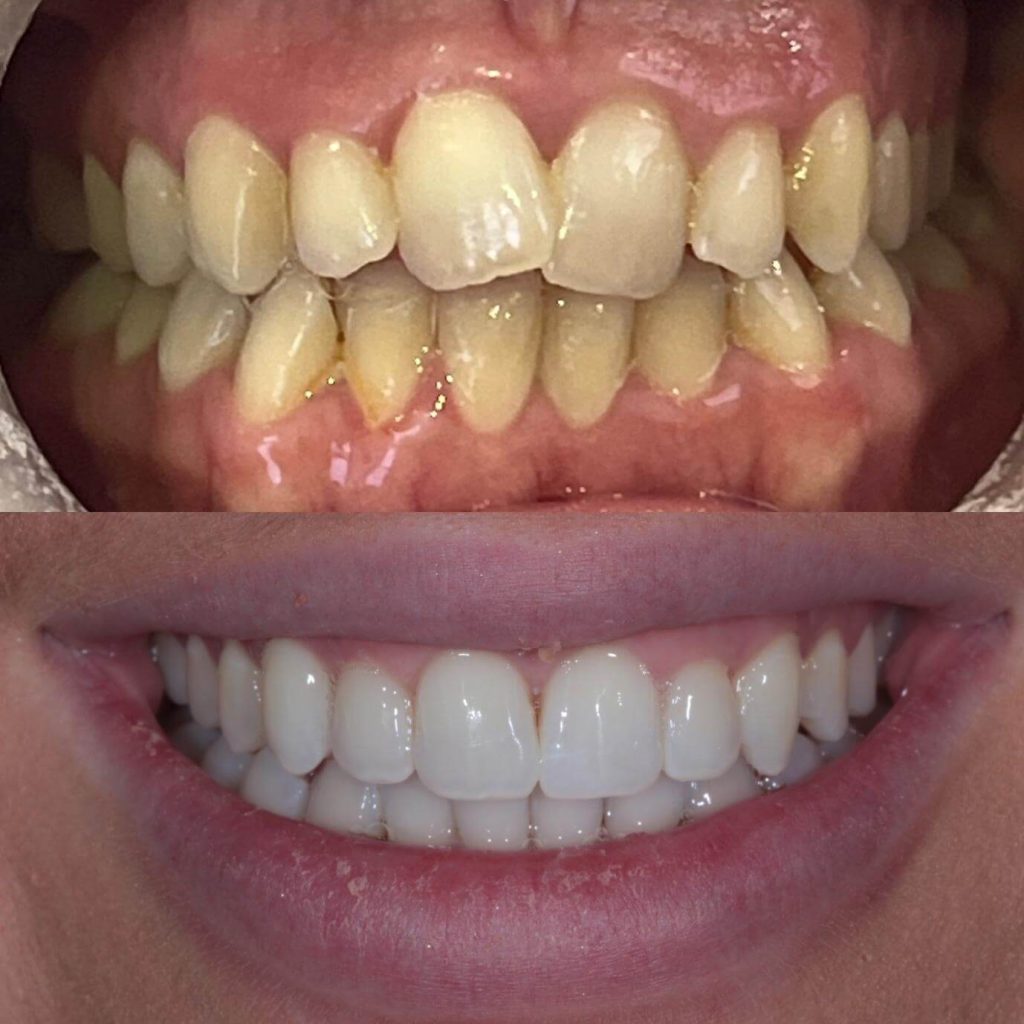 Invisalign Case