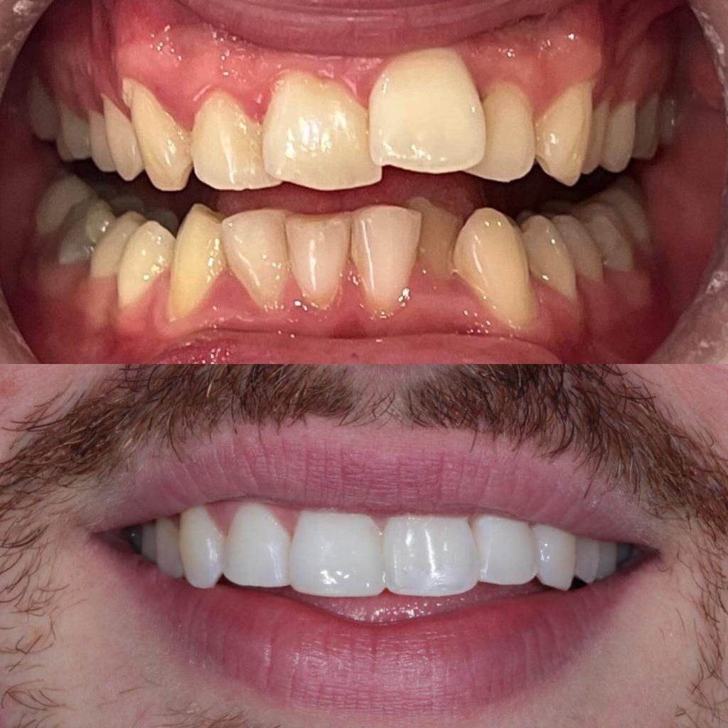 Invisalign Case